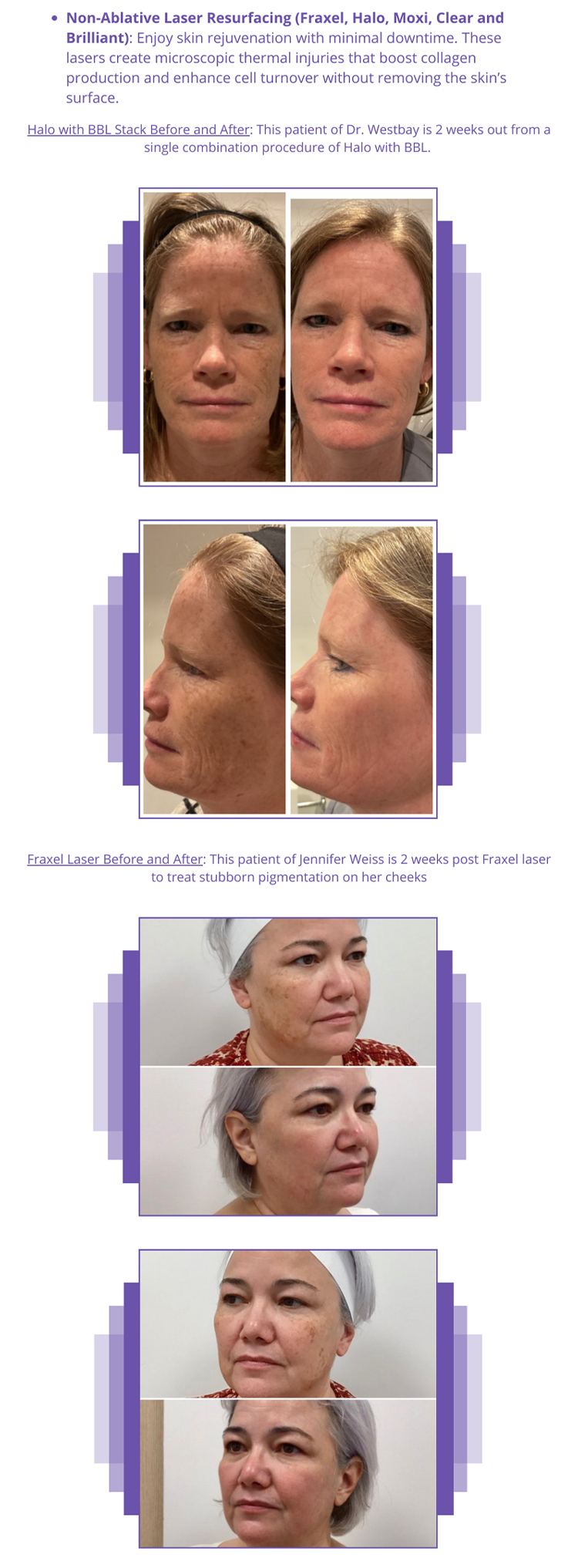 Non Ablative Laser
